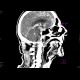 Subarachnoid hemorrhage: CT - Computed tomography